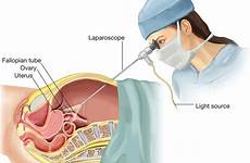 laparoscopy surgery fibroids endometriosis laparoscopic hysteroscopy types endoscopy laproscopy fibroid ovarian lerablog uterine causes symptoms cyst recovery treatment