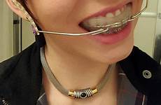 braces headgear brace milwaukee dental chain