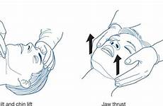 surgery problems clinical jaw thrust lift chin tilt head marshall hunt ed 2a figure