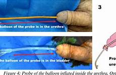 urethral catheterization