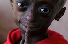 progeria bolezni solace redkih podpora pretoria resembles