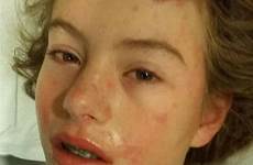 vicky archer swns mum horrifying suffering bristol horrific illness identify attacking desperate bid daughter bleeding swollen lips