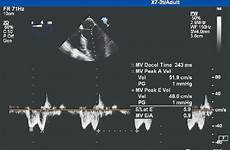 mitral velocity transmitral diastolic doppler inflow