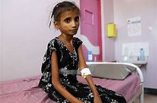 yemen children malnutrition famine