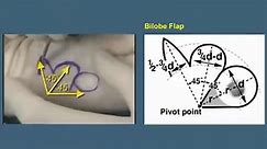 Bilobe Flap - Skin... - Clinical Anatomy & Operative Surgery