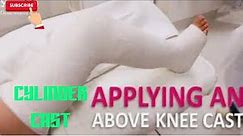 How to apply an cylinder cast Above Knee Cast pop