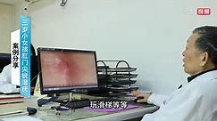 男性尖锐湿疣临床实录CXXIX-南京优嘉病毒疣医学研究所