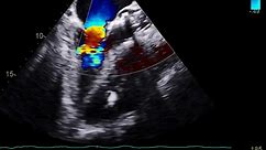 Postoperative Transesophageal Echocardiogram Showing Reduced Flow Through the Fistula