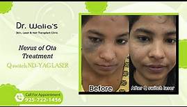 Nevus of Ota Treatment I Qswitch Ndyag laser I Dr Walia's Skin and Hair Transplant Clinic