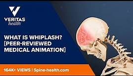 What Is Whiplash? [Peer-reviewed Medical Animation]