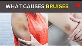 Bruises - Why does it happens? | Symptoms, Causes and treatment