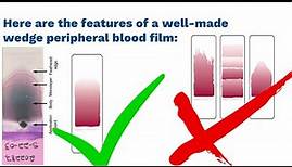 Mastering Blood Film Preparation and Examination