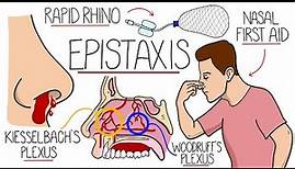 Understanding Epistaxis (Nosebleeds Explained)