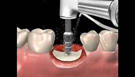 Step by step dental implant surgery. Gary R. O'Brien, D.D.S.