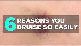 6 Reasons You Bruise So Easily | Health
