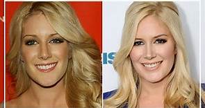 Heidi Montag Amazing Transformation | Before and After Plastic Surgery