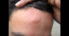 Head Injury Bump- Home Treatment