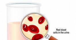 14 Causes Of Blood In Urine (Hematuria) In Child & Treatment