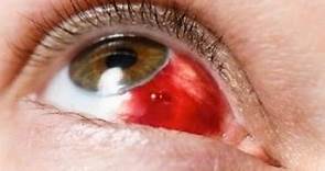 Derrame Ocular (Hemorragia Subconjuntival)