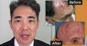 900 Reconstructed Scalps after Skin Cancer —Video Discussion by Matthew Hanasono, MD