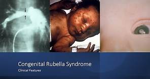 Congenital Rubella Syndrome: Early and Late Onset Manifestations
