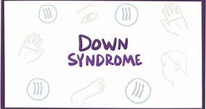 Down syndrome (trisomy 21) - causes, symptoms, diagnosis, & pathology