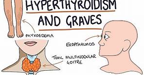 Understanding Hyperthyroidism and Graves Disease