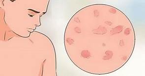 ¿Qué es la psoriasis guttata?