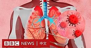 肺炎疫情：新冠病毒如何影響我們的身體？－ BBC News 中文