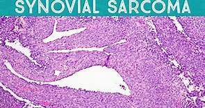 Synovial Sarcoma (explained in 5 minutes): Soft Tissue Pathology Basics