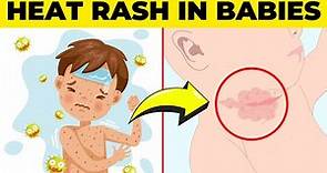 Heat Rash in Babies Explained: Causes, Symptoms & Effective Home Remedies