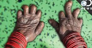 What Happens When You Get Leprosy?