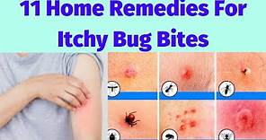 11 Home Remedies For Itchy Bug Bites