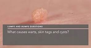 What causes warts, skin tags and cysts?
