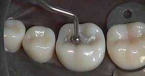 Class I Amalgam Preparation & Restoration | Operative Dentistry