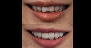 【有影】牙齒美白做「貼片」傷神經？鬧蛀牙？ 牙醫專業QA告訴你