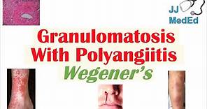 Granulomatosis with Polyangiitis (Wegener’s granulomatosis) | Symptoms, Diagnosis, Treatment
