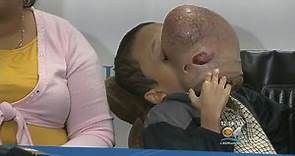 UM Health Doctors To Remove 10 Pound Tumor From Teen's Face