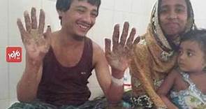 Tree Man of Bangladesh Cured After Undergoing 16 Surgeries | YOYO TV English