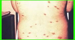 皮膚科醫生：皮膚上長出這種毒疹，你可能感染了愛滋病！