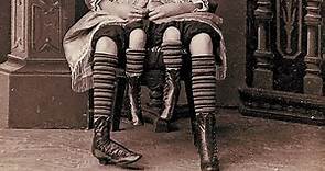 The Story Of Myrtle Corbin, The Real Four Legged Girl