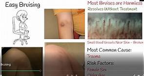 Easy bruising - Why It Happens, When To Be Concerned