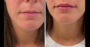 #filler #labbra con cannula effetto naturale correzione labbro ad "emme" dr Luca Zattoni