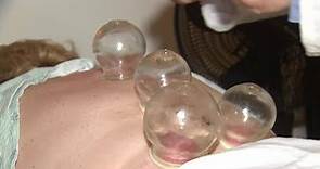 What are the health benefits of 'cupping?'