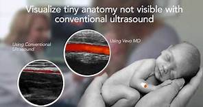 Vevo MD - The World's First Ultra-High Frequency Ultrasound System