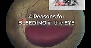 4 Reasons for BLEEDING in the EYE/ Blood clot in the eye