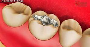 What are Amalgam Fillings? When is it used?