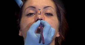 Déroulement d'une Rhinoplastie par injection d'acide hyaluronique pour corriger la bosse du nez