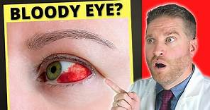 Broken Blood Vessel And Bloodshot Eye?! - Subconjunctival Hemorrhage (Causes, Treatment)