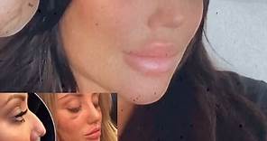 Charlotte Crosby says she’s glad she got rid of the ‘hook’ in her nose as she shares before and after surgery